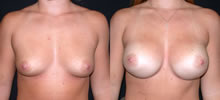 Breast Augmentation 10