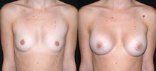 Breast Augmentation 11