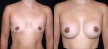 Breast Augmentation 9