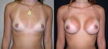 Breast Augmentation 1