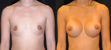 Breast Augmentation 16