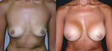 Breast Augmentation 2