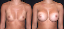 Breast Augmentation 25