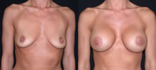 Breast Augmentation 6