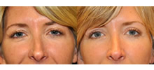 Eyelid Lift Patient
