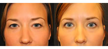 Eyelid Lift Patient