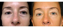 Eyelid Lift Patient