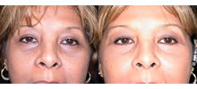 Eyelid Lift Patient