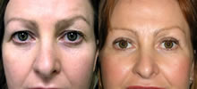 Eyelid Lift Patient