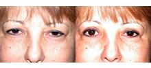 Eyelid Lift Patient