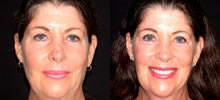 Facelift Patient