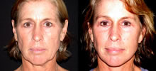 Facelift Patient