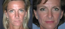 Facelift Patient