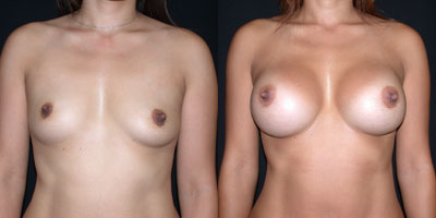 Breast augmentation before and after photo
