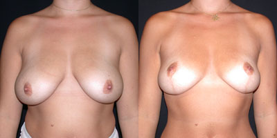 Breast lift photo
