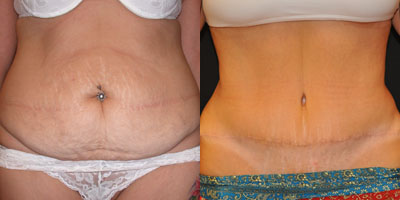 Tummy tuck
